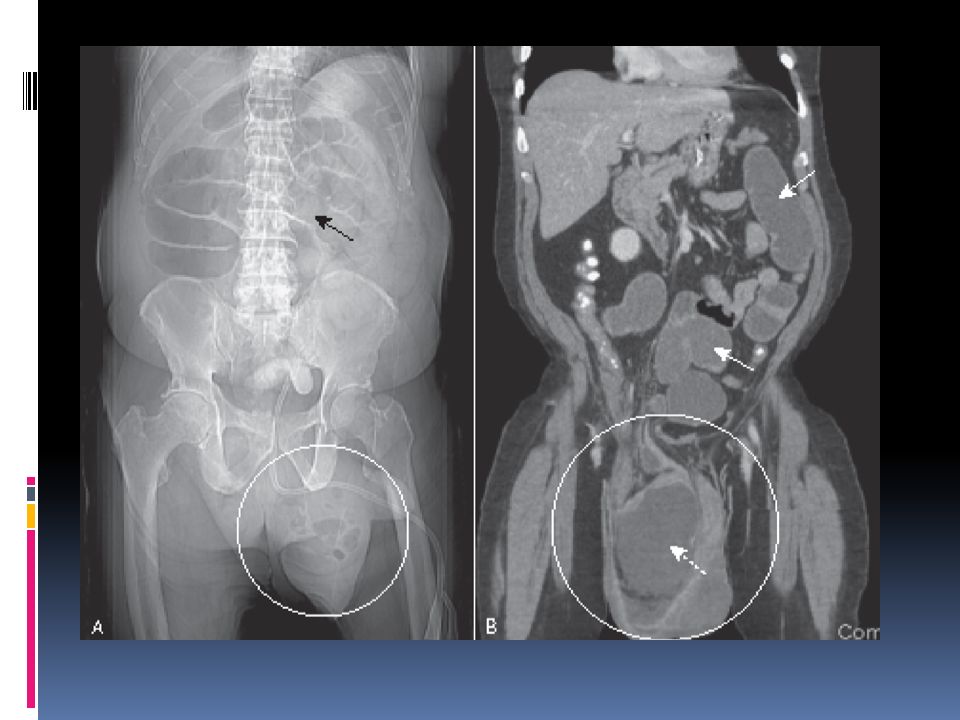 Small bowel obstruction from inguinal hernia