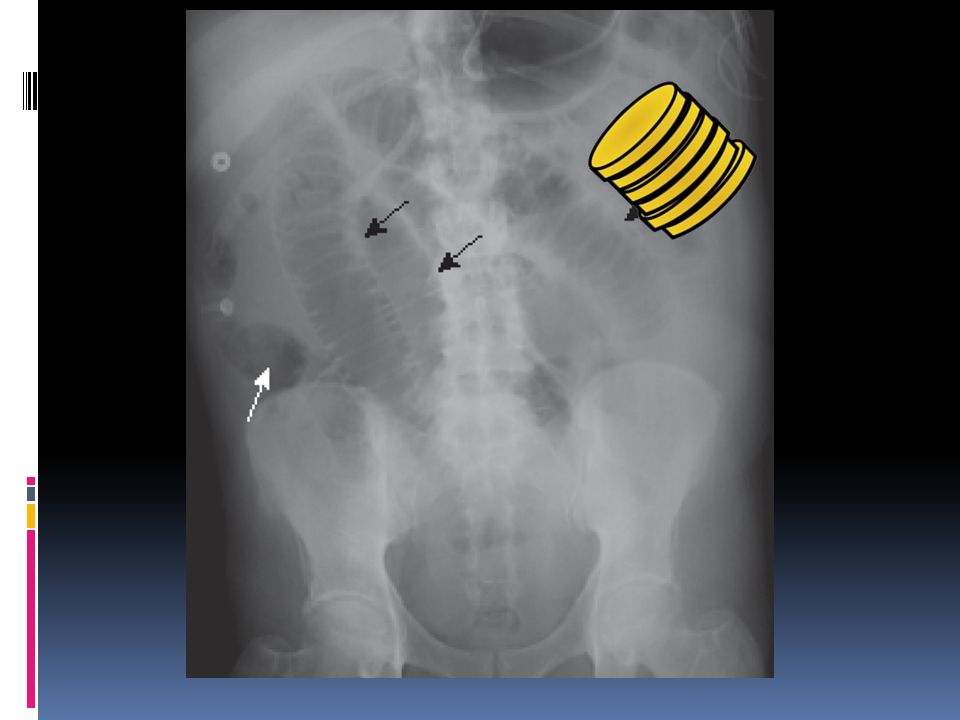 Mechanical small bowel obstruction
