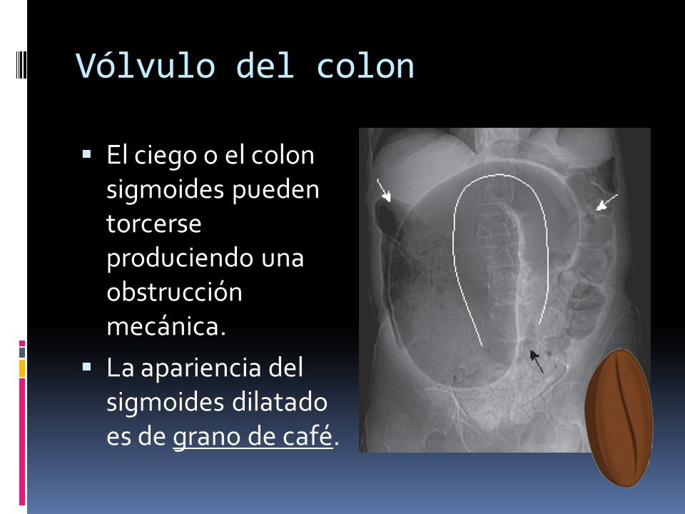 Vólvulo del colon El ciego o el colon sigmoides pueden torcerse produciendo una obstrucción mecánica.