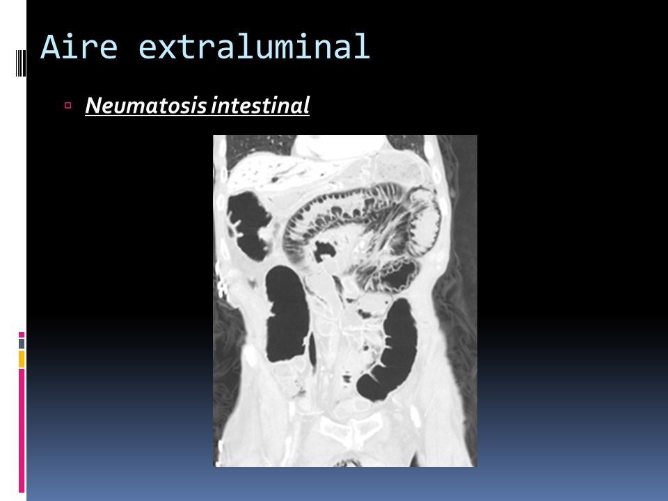 Aire extraluminal Neumatosis intestinal
