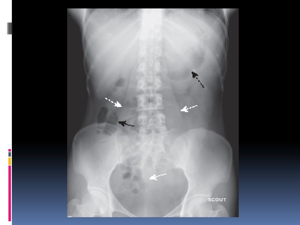 Normal supine abdomen. This is the scout film of the abdomen, the one that gives a general idea of the bowel gas pattern and allows you to search for radiopaque calculi and detect organomegaly.