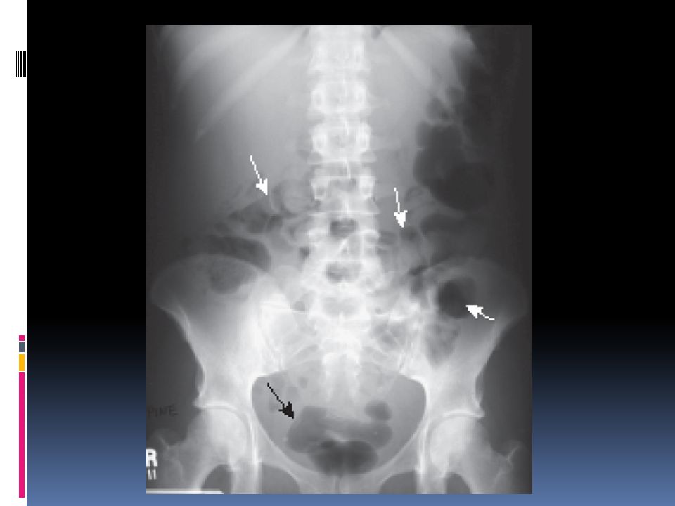 Normal prone abdomen. In the prone position, the ascending and descending colon and the rectosigmoid-all posterior structures-are the highest parts of the large bowel and thus most likely to fill with air.