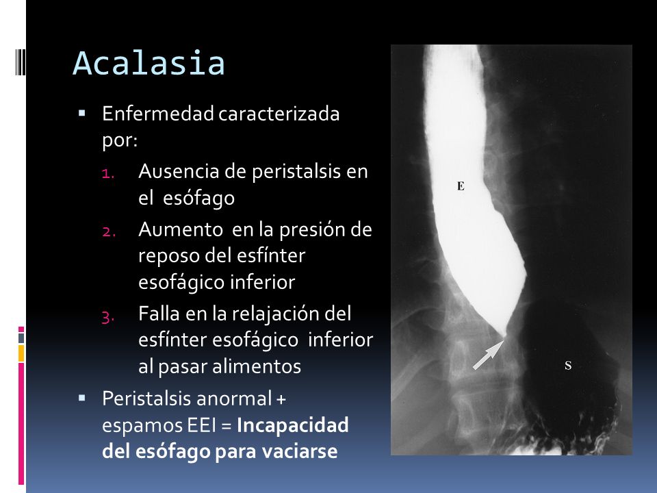 Acalasia Enfermedad caracterizada por:
