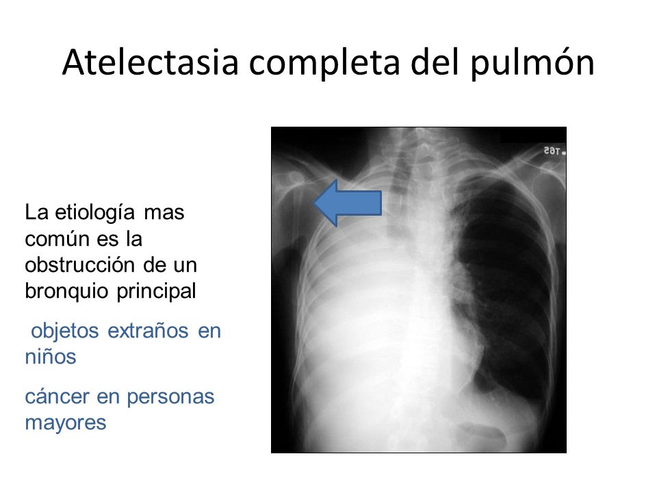 Atelectasia completa del pulmón