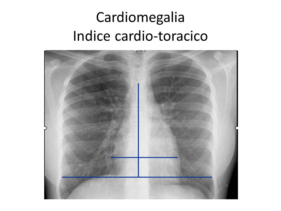 Cardiomegalia Indice cardio-toracico