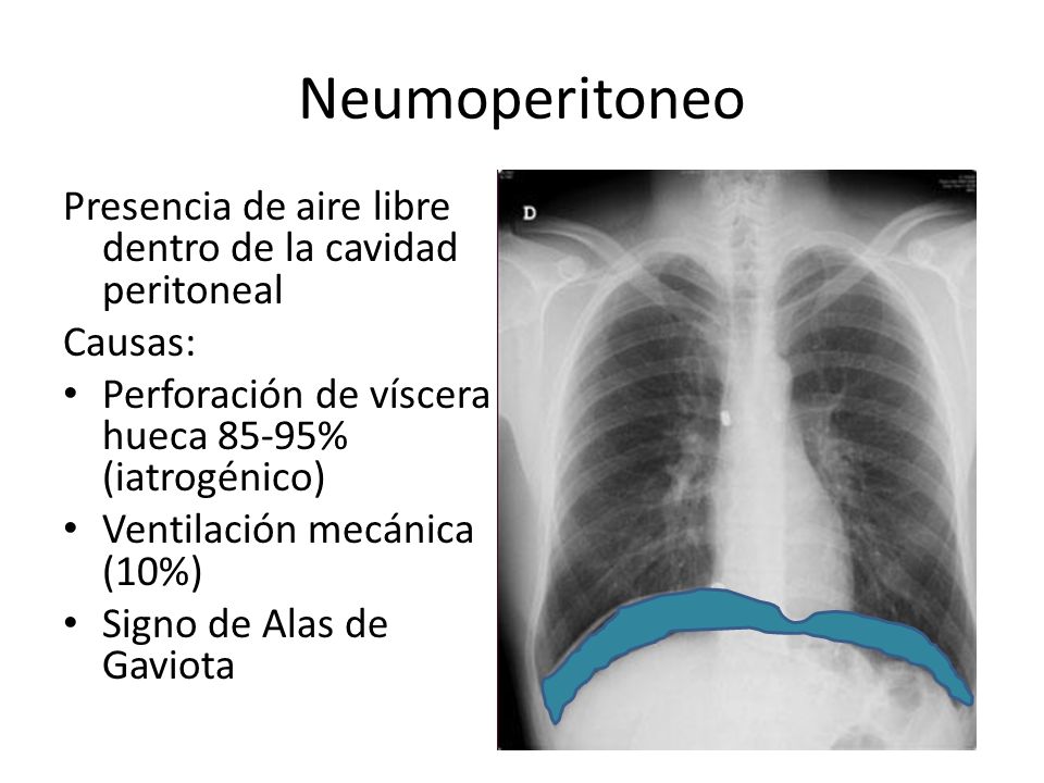 Neumoperitoneo Presencia de aire libre dentro de la cavidad peritoneal