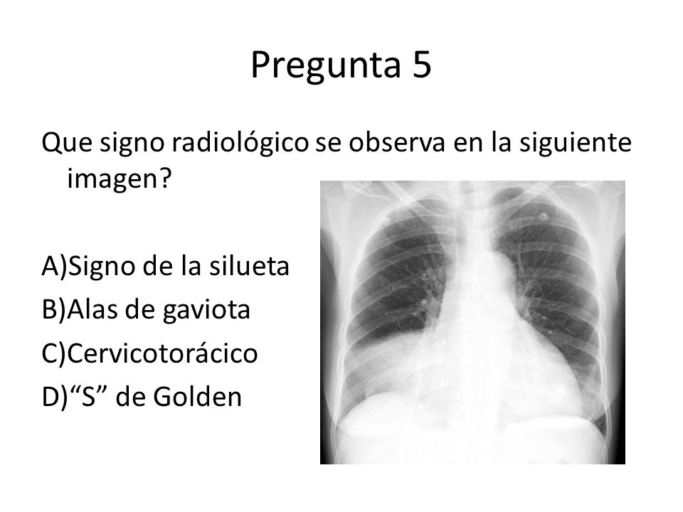 Pregunta 5 Que signo radiológico se observa en la siguiente imagen