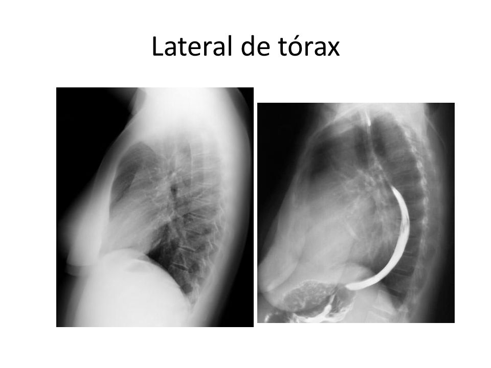 Lateral de tórax