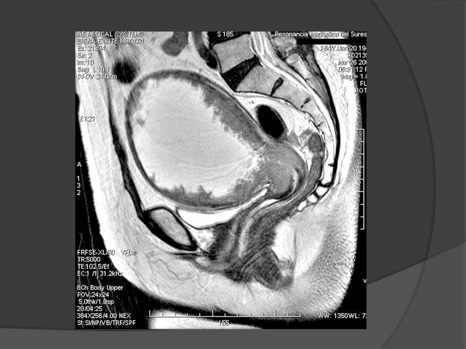 Paciente menopáusica con carcinoma de endometrio estadio IIB (invasión del estroma cervical y miometrial profundo)
