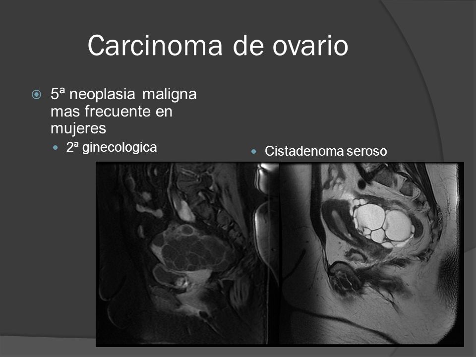 Carcinoma de ovario 5ª neoplasia maligna mas frecuente en mujeres