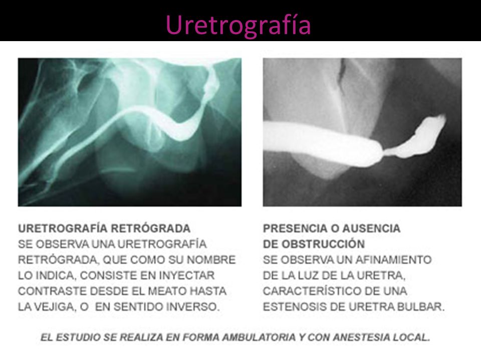 Uretrografía Indicaciones: buscar estenosis, divertículos, tumores o traumatismos ureterales