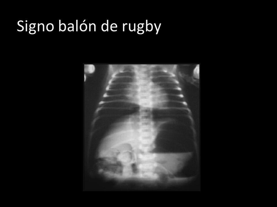 Signo balón de rugby Se da por presencia de aire en ambos lados de hígado, delimitando así sus bordes.