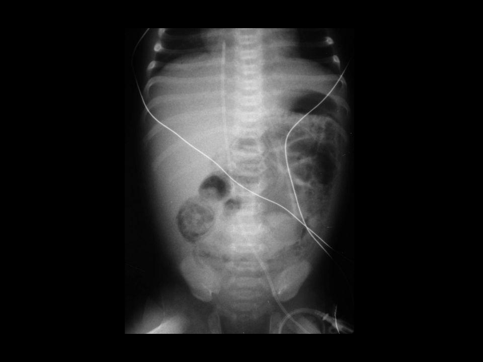 Radiografía simple de abdomen en paciente neonato con cuadro clínico de enterocolitis necrotizante, en la que se observa, la presencia de gas en la pared intestinal.