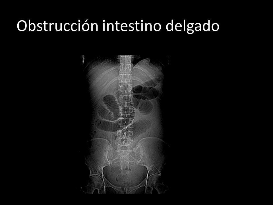Obstrucción intestino delgado