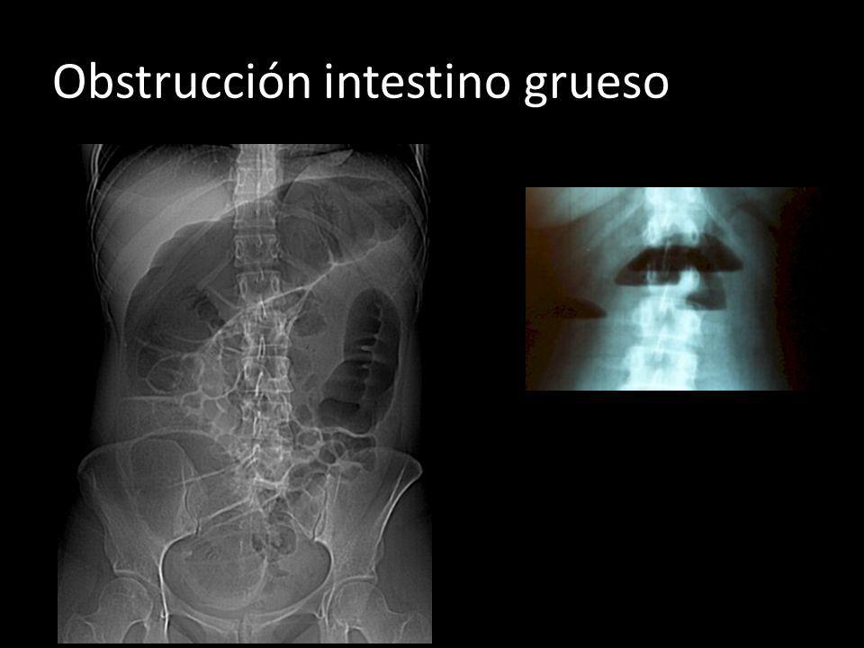 Obstrucción intestino grueso