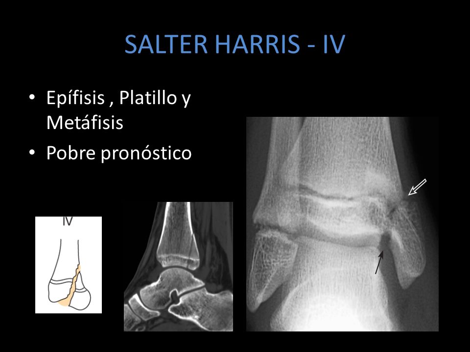SALTER HARRIS - IV Epífisis , Platillo y Metáfisis Pobre pronóstico