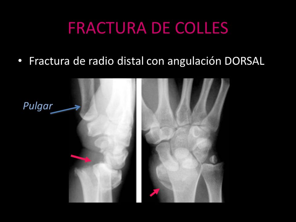 FRACTURA DE COLLES Fractura de radio distal con angulación DORSAL