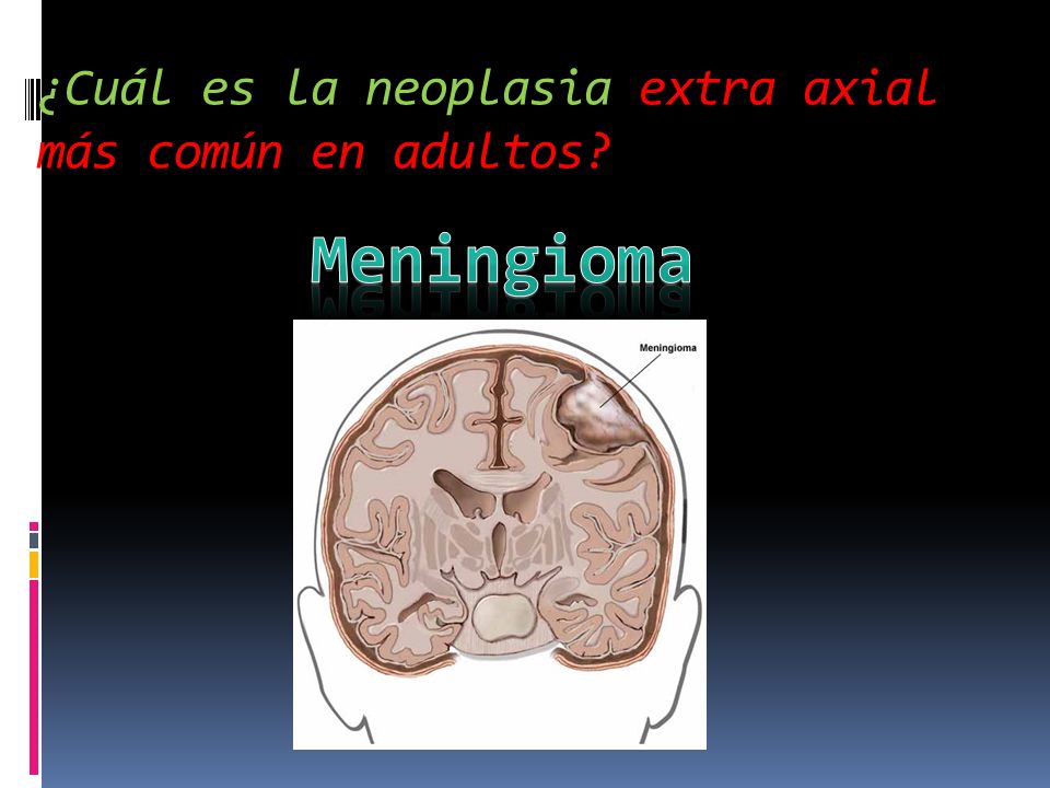 ¿Cuál es la neoplasia extra axial más común en adultos