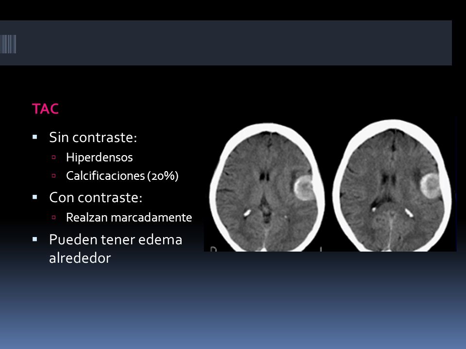 Neuroradiología II. - ppt video online descargar