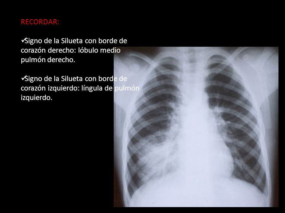 RECORDAR: Signo de la Silueta con borde de corazón derecho: lóbulo medio pulmón derecho.