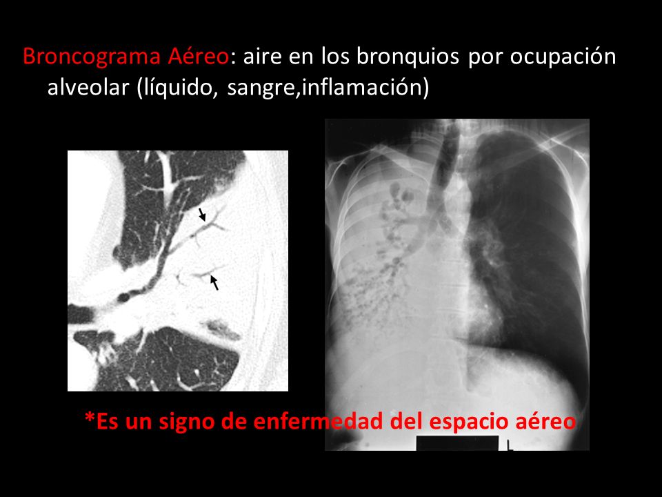 Broncograma Aéreo: aire en los bronquios por ocupación alveolar (líquido, sangre,inflamación) *Es un signo de enfermedad del espacio aéreo