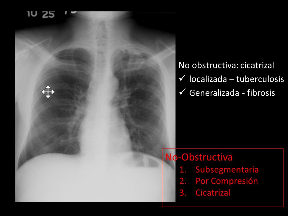 No-Obstructiva No obstructiva: cicatrizal localizada – tuberculosis