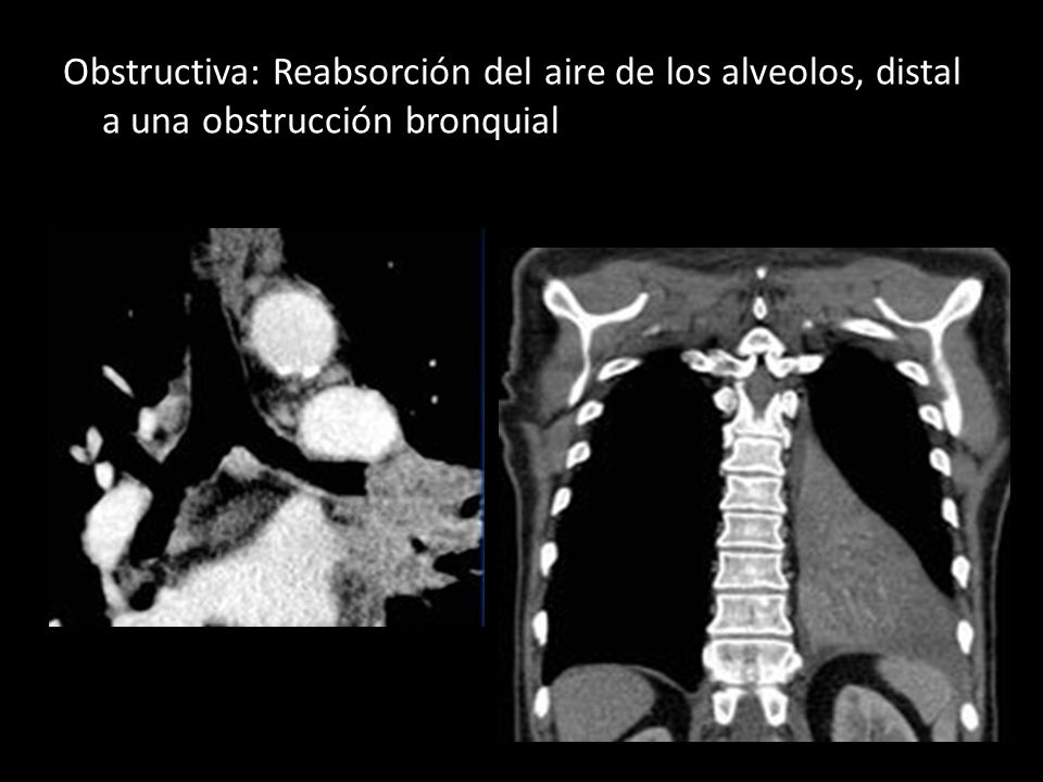 Obstructiva: Reabsorción del aire de los alveolos, distal a una obstrucción bronquial
