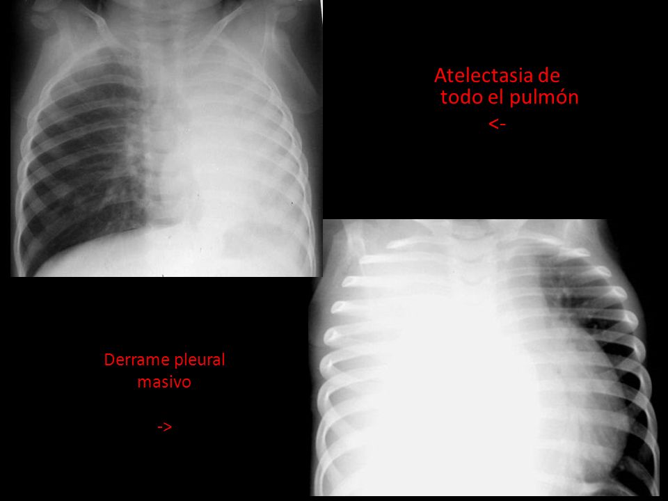 Atelectasia de todo el pulmón <-
