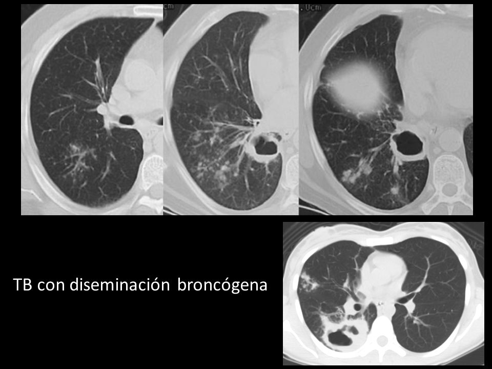 TB con diseminación broncógena