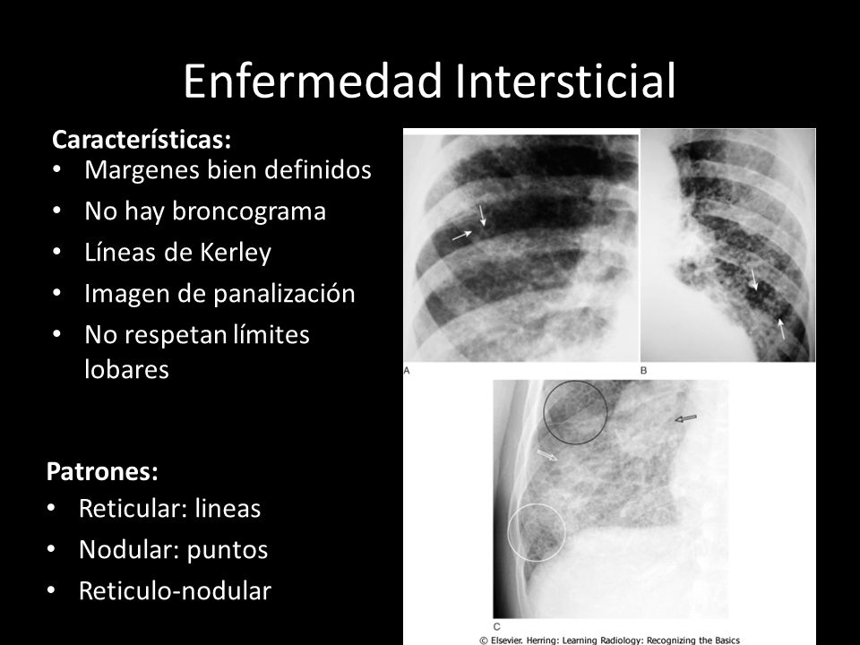 Enfermedad Intersticial