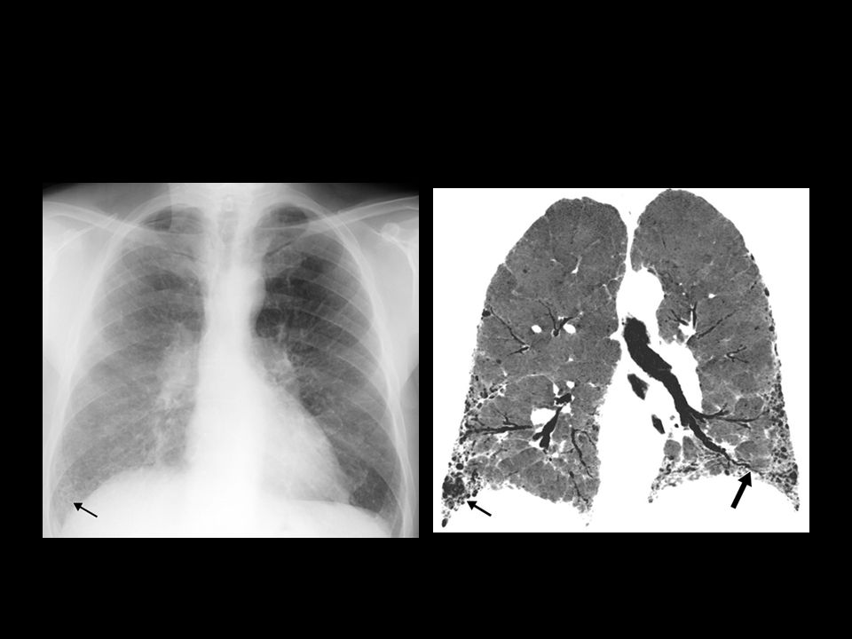 FPI con patrón típico. A) Radiografía de tórax posteroanterior: quistes de panal en base derecha (flecha).