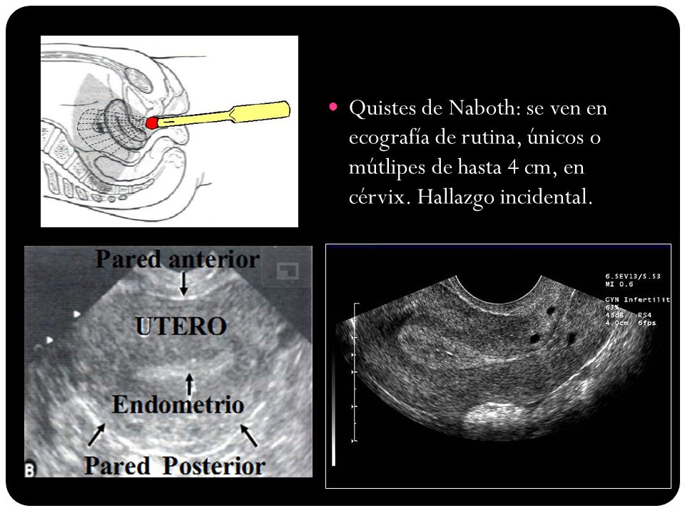 Quistes de Naboth: se ven en ecografía de rutina, únicos o mútlipes de hasta 4 cm, en cérvix. Hallazgo incidental.