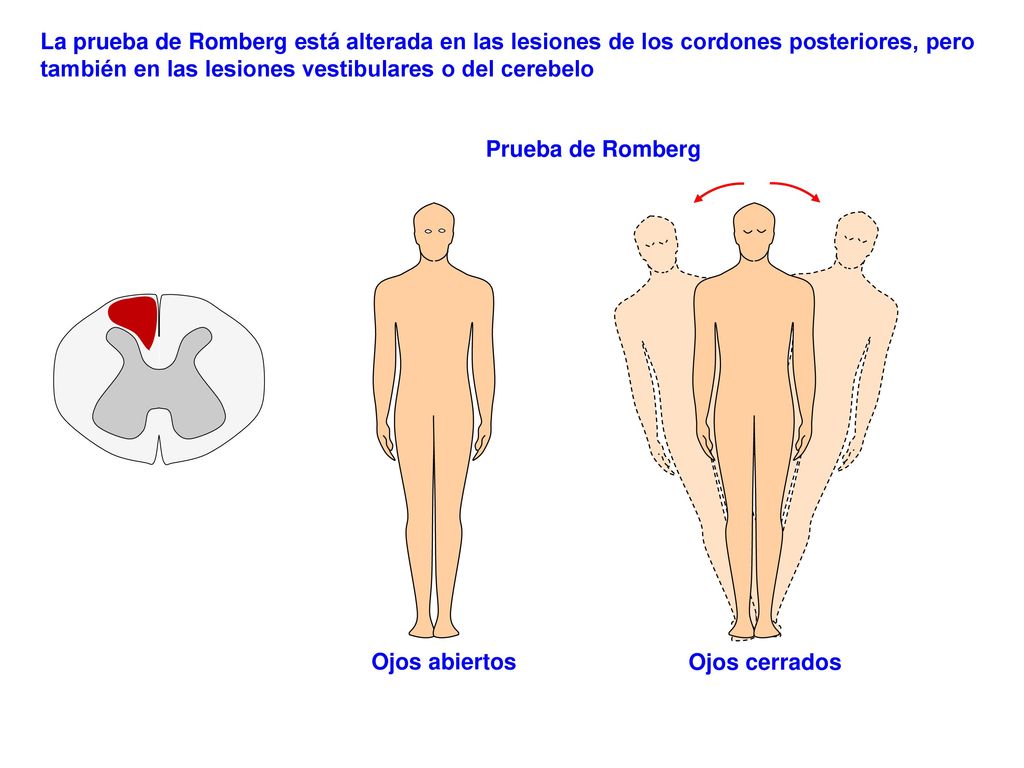 La prueba de Romberg está alterada en las lesiones de los cordones posteriores, pero también en las lesiones vestibulares o del cerebelo