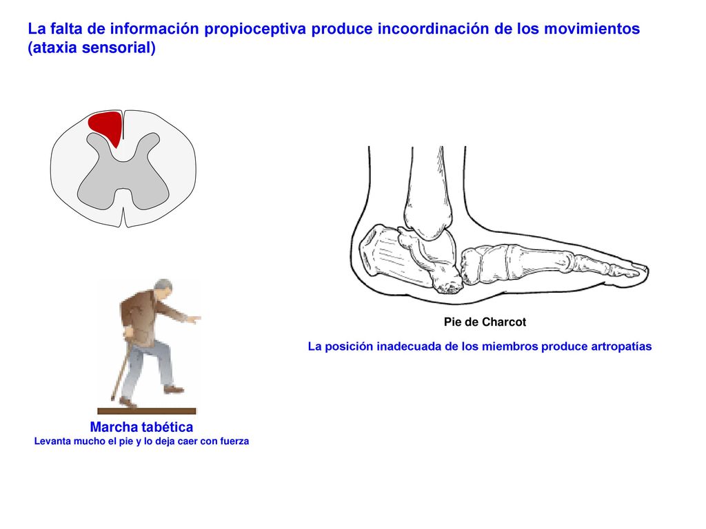 La falta de información propioceptiva produce incoordinación de los movimientos (ataxia sensorial)