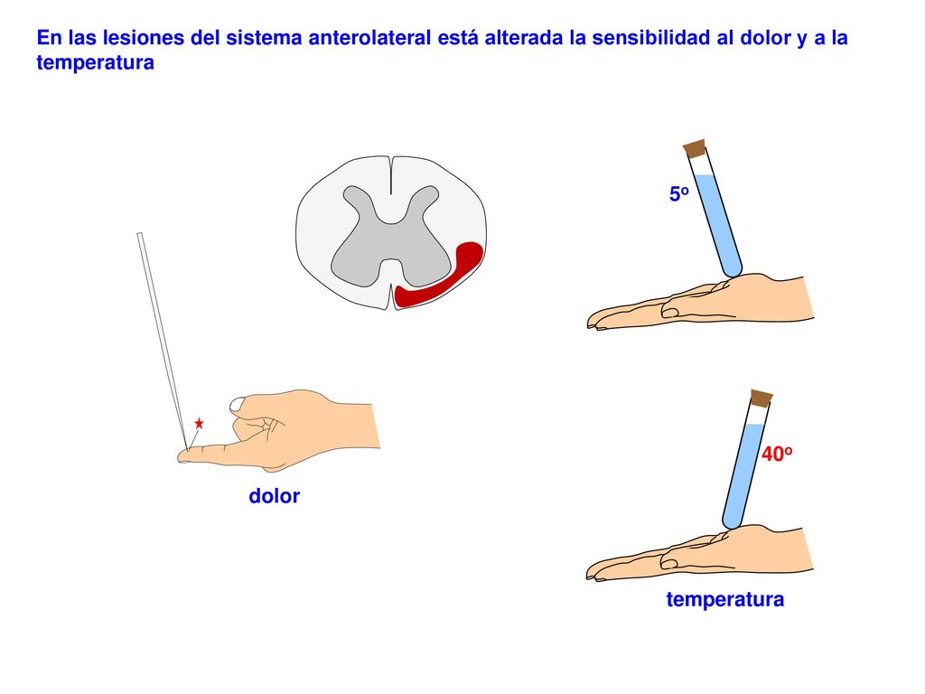En las lesiones del sistema anterolateral está alterada la sensibilidad al dolor y a la temperatura