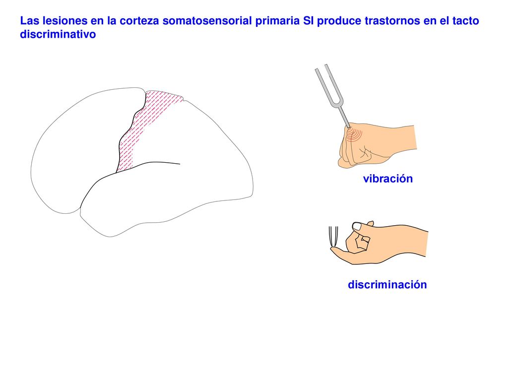 Las lesiones en la corteza somatosensorial primaria SI produce trastornos en el tacto discriminativo