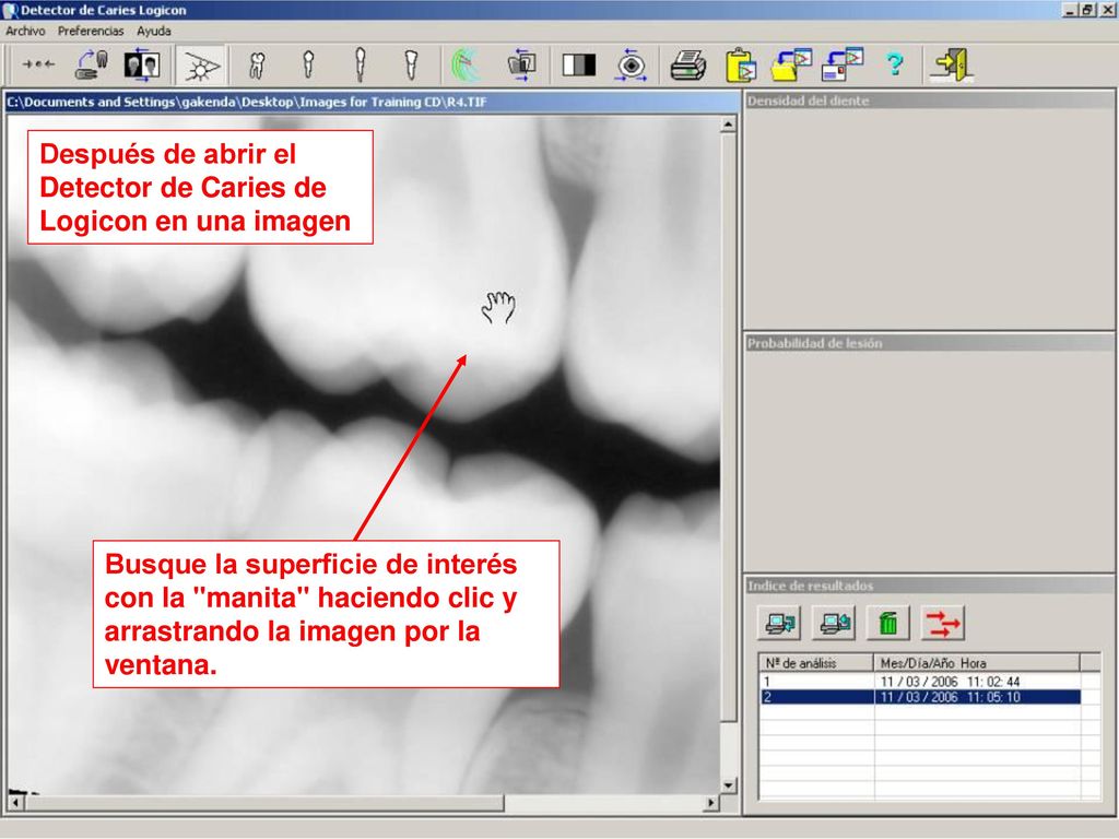 Después de abrir el Detector de Caries de Logicon en una imagen
