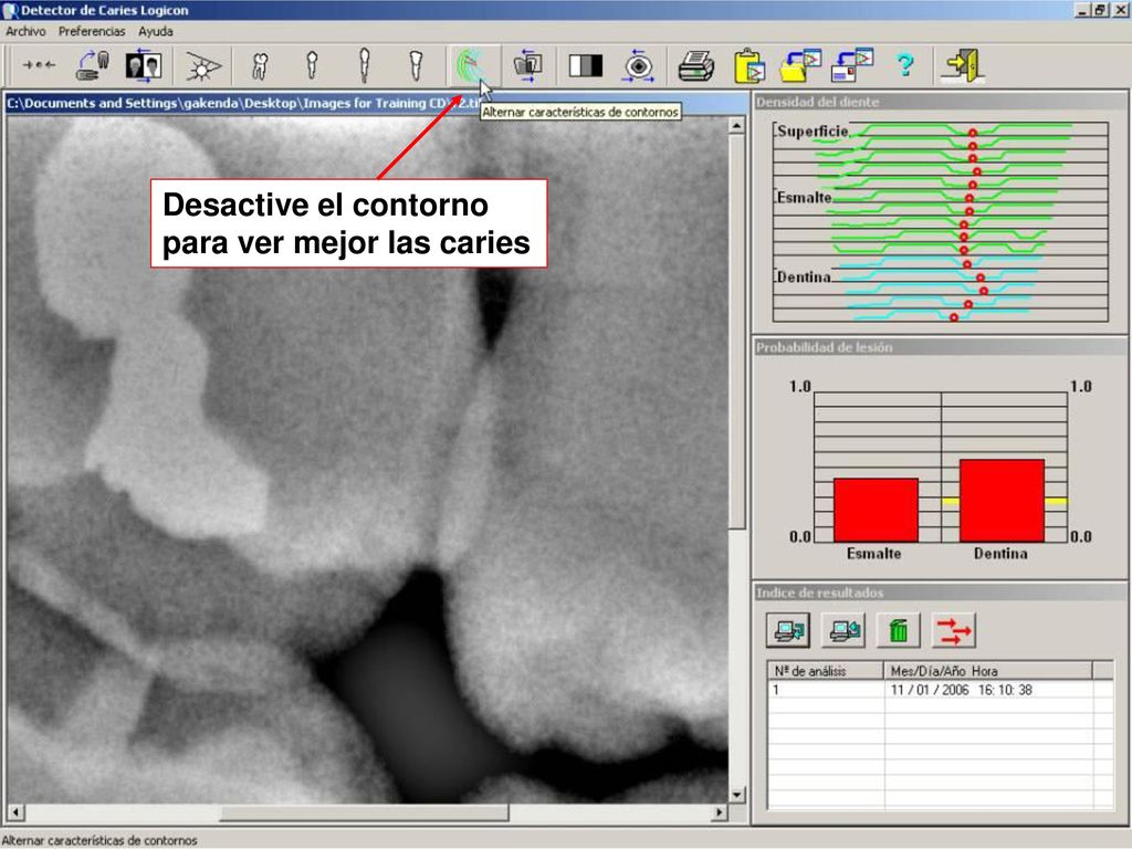 Desactive el contorno para ver mejor las caries