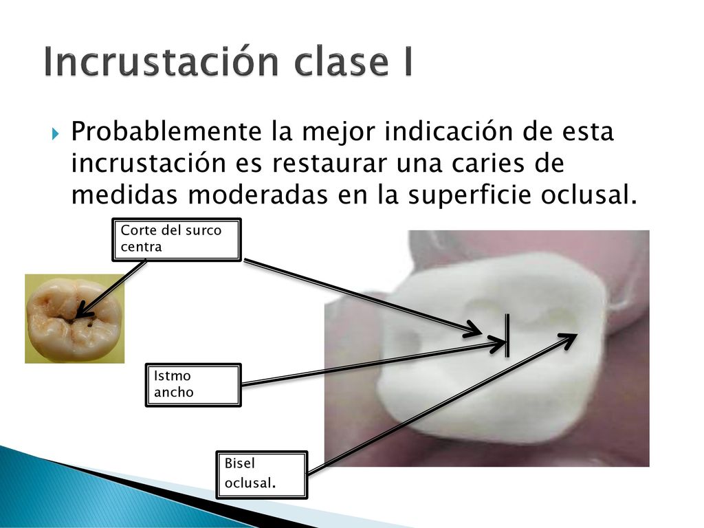 Incrustación clase I Probablemente la mejor indicación de esta incrustación es restaurar una caries de medidas moderadas en la superficie oclusal.