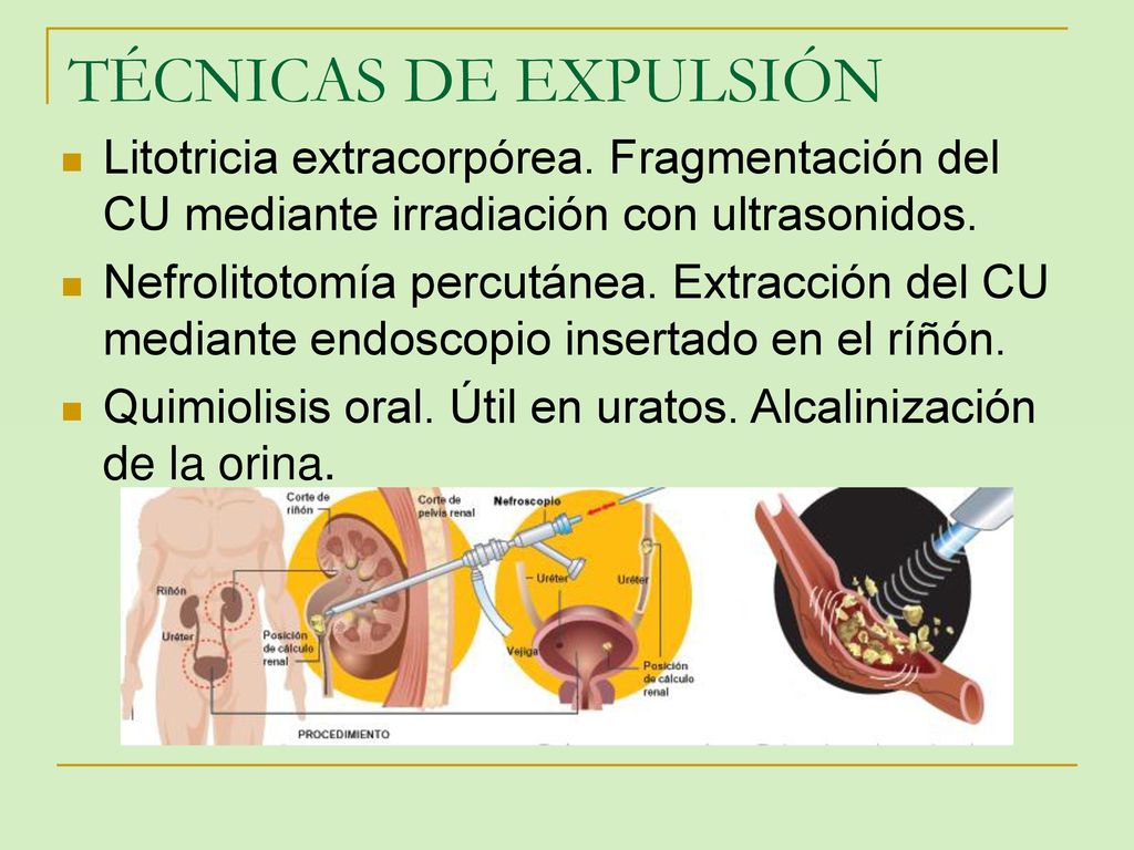 TÉCNICAS DE EXPULSIÓN Litotricia extracorpórea. Fragmentación del CU mediante irradiación con ultrasonidos.