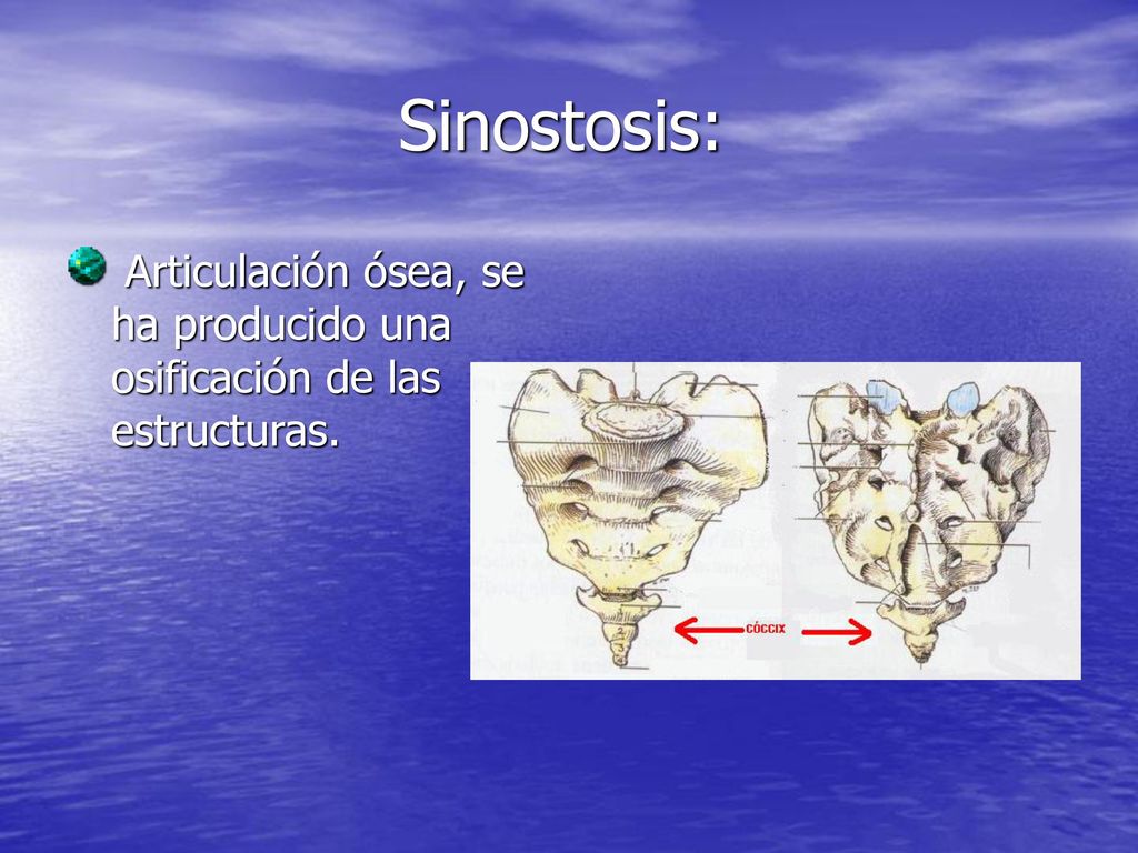 Sinostosis: Articulación ósea, se ha producido una osificación de las estructuras.