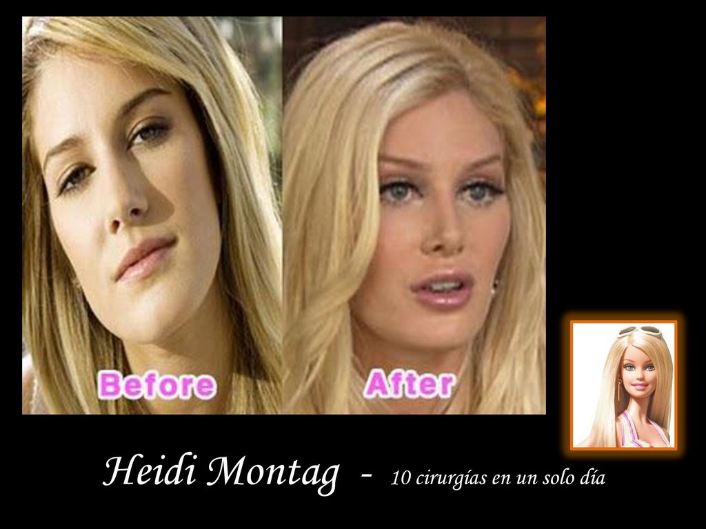Heidi Montag - 10 cirurgías en un solo día