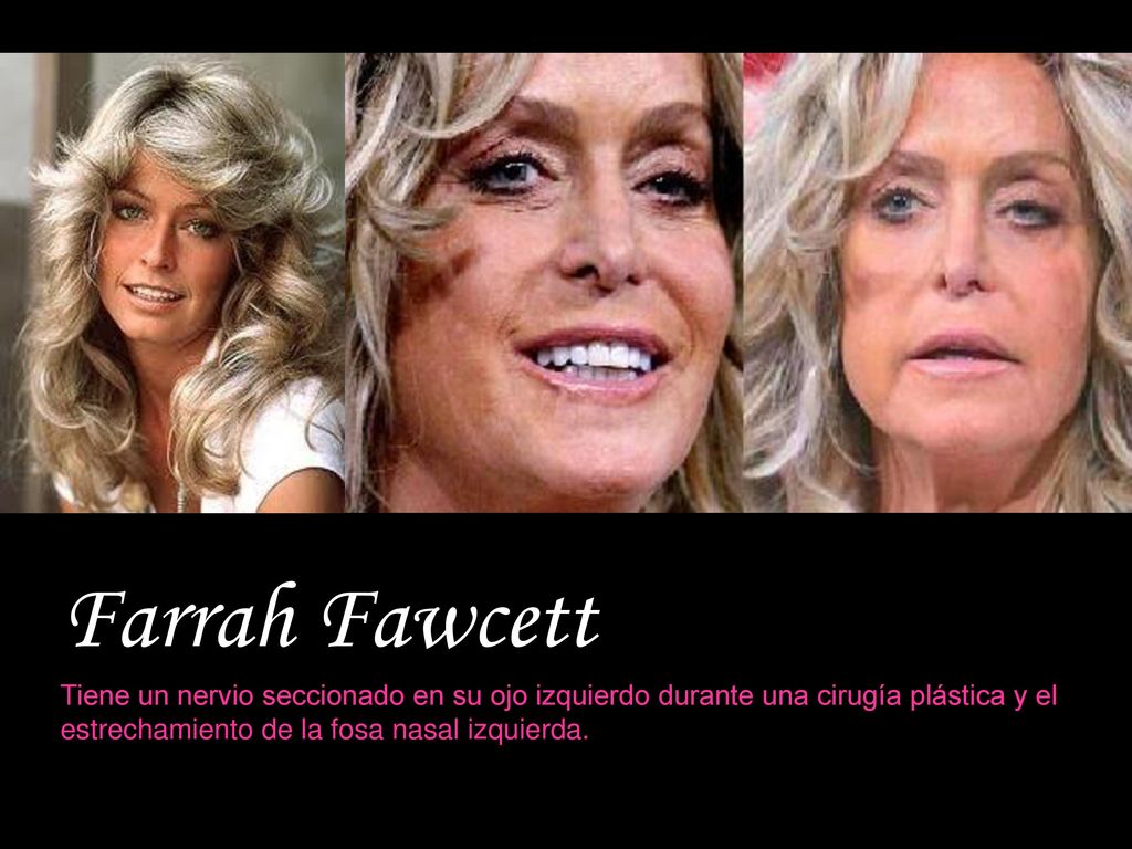 Farrah Fawcett - teve um nervo no olho esquerdo seccionado durante uma das cirurgias plásticas e estreitamento da narina esquerda.