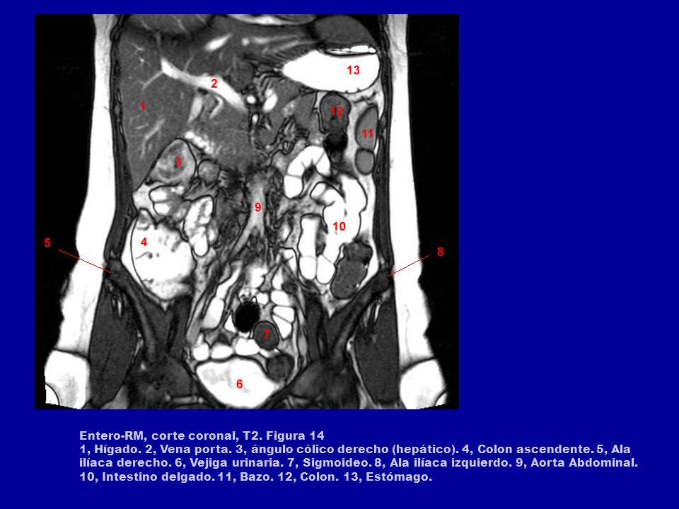 Entero-RM, corte coronal, T2. Figura 14