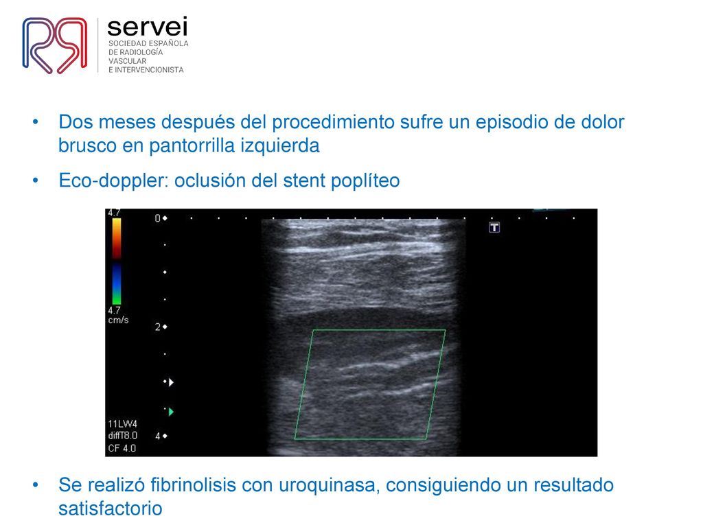 Dos meses después del procedimiento sufre un episodio de dolor brusco en pantorrilla izquierda