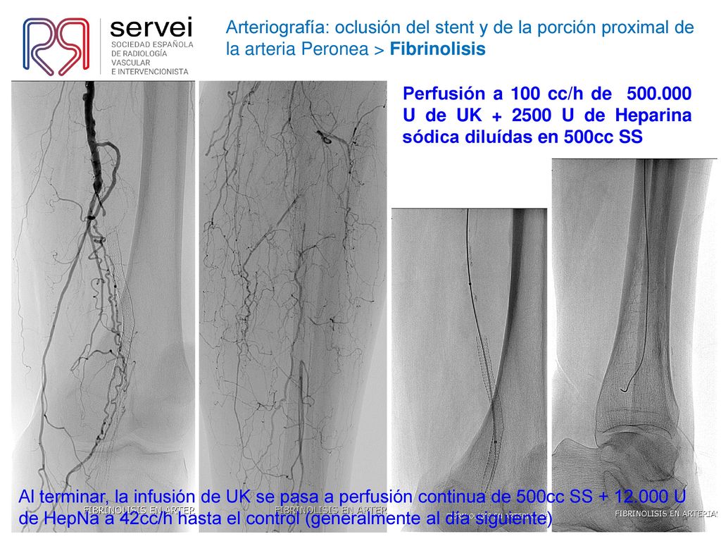 Arteriografía: oclusión del stent y de la porción proximal de la arteria Peronea > Fibrinolisis