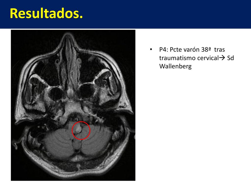 Resultados. P4: Pcte varón 38ª tras traumatismo cervical Sd Wallenberg