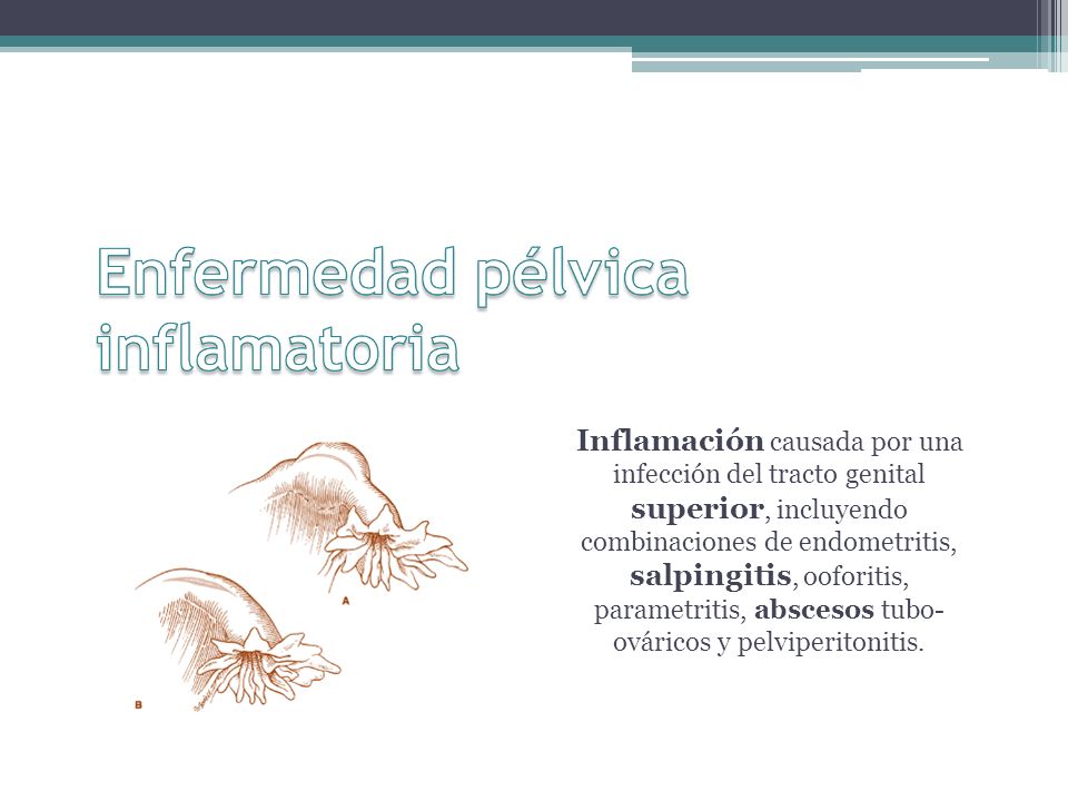 Inflamación causada por una infección del tracto genital superior, incluyendo combinaciones de endometritis, salpingitis, ooforitis, parametritis, abscesos tubo- ováricos y pelviperitonitis.
