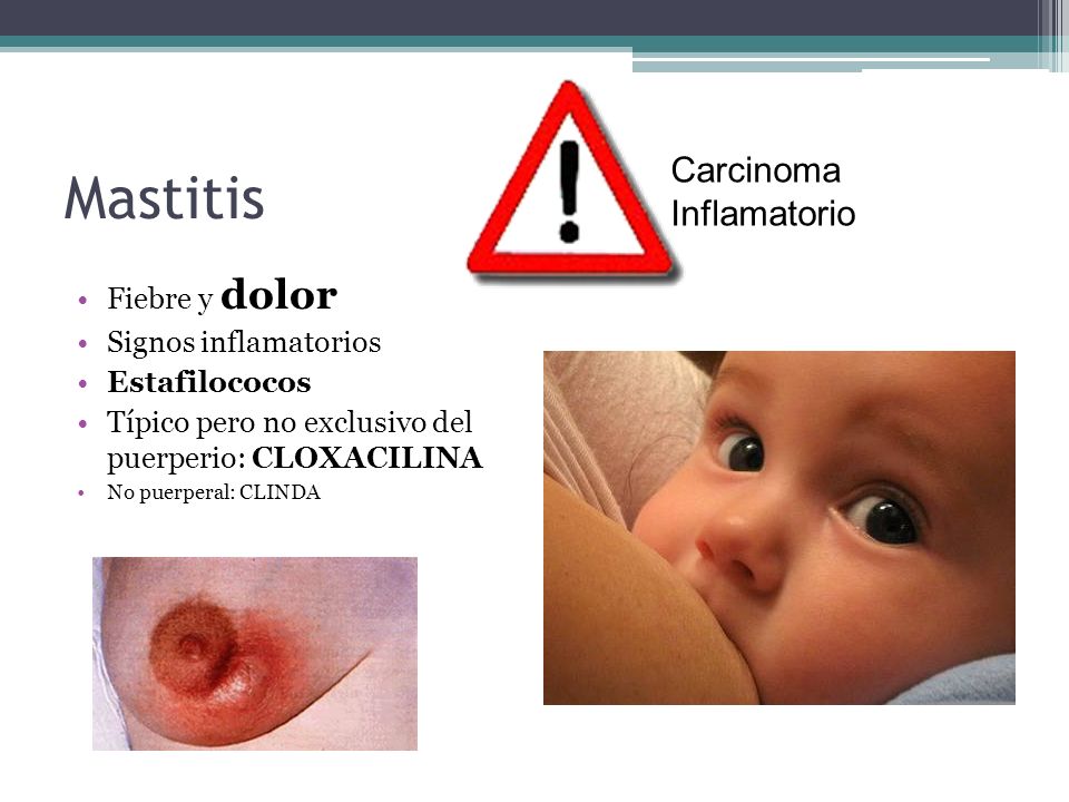 Mastitis Carcinoma Inflamatorio Fiebre y dolor Signos inflamatorios