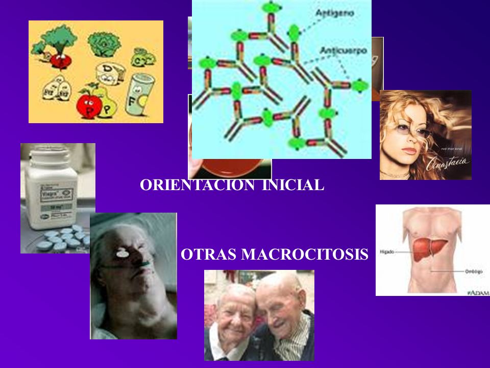 ORIENTACION INICIAL OTRAS MACROCITOSIS